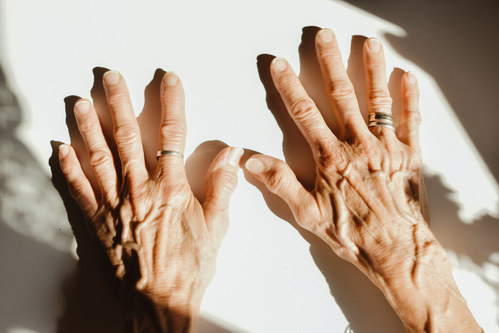 Living Well with Rheumatoid Arthritis: Engaging Patients Highlights the Unmet Need